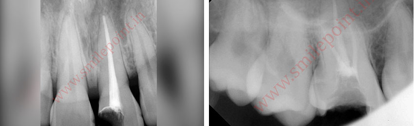 Root Canal Treatment