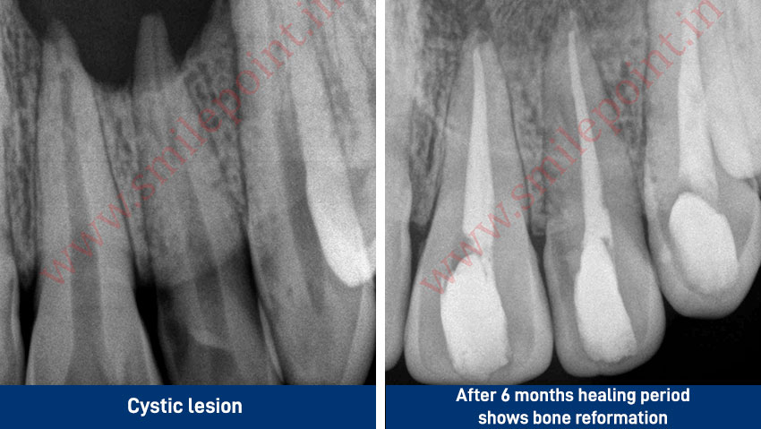 Root Canal Treatment