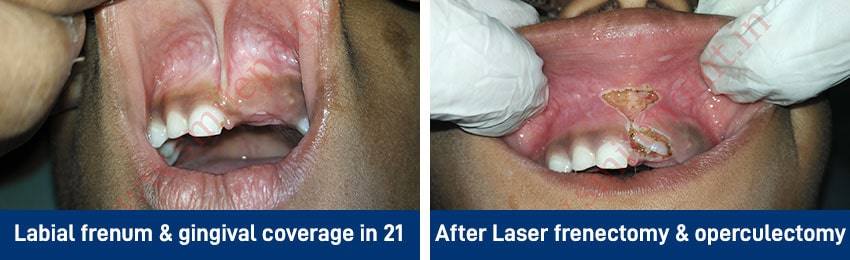 Laser Dentistry